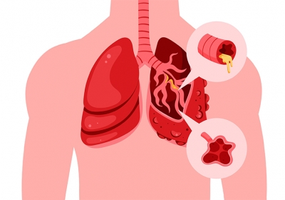 Проследяване на ХОББ от професор Полоса